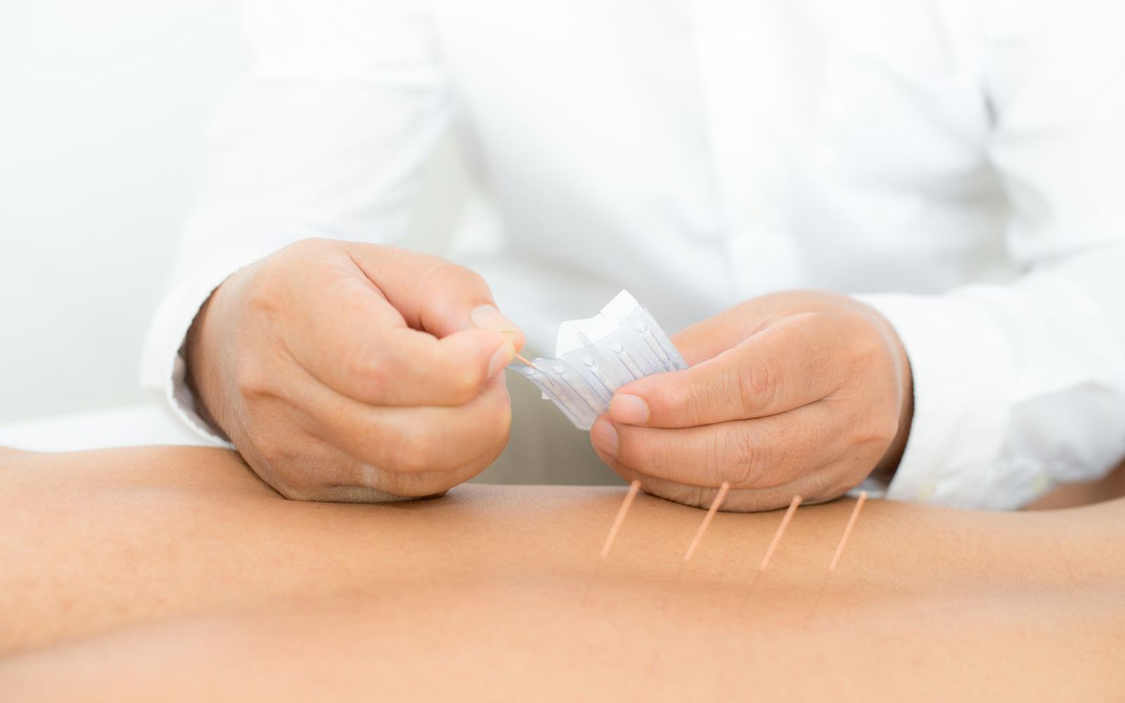 Acupunctură medicală